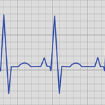 EKG